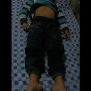 Boy With Sydenham S Chorea And Sydenham S Chorea Or St Vitus S Dance