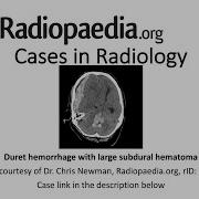 Duret Hemorrhage With Large Subdural Hematoma Radiopaedia Org Cases In Radiology