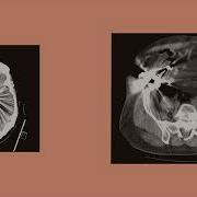 What Is The Beam Hardening Artifact Computed Tomography CT Physics