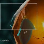 Glaucoma Overview