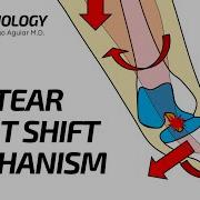 Pivot Shift Mechanism Of ACL Tear How The MRI Bone Marrow Edema Occurs