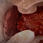 The Biology Of Metastatic Bone Disease