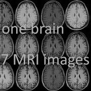 One Brain 557 MRI Images