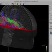 Tractography Of Arcuate Fasciculus Using MRtrix3