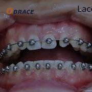Ligation Method For OBRACE Bracket 3 Laceback