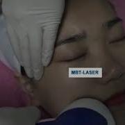 Home Used Thermolift RF Head Face Lift Machine