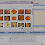 Diabetic Retinopathy Detection Using Neural Network Matlab Project Code