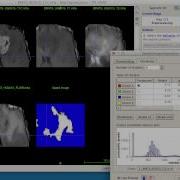 Semi Automatic Brain Tumor Segmentation In Multi Modality MRI Using ITK SNAP 3 0