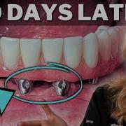 All On 4 REGRETS Final PERMANENT Teeth In 24 Hours PROBLEMS