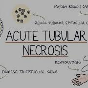 Understanding Acute Tubular Necrosis