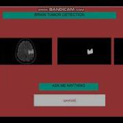 Brain Tumor Detection Using Matlab Image Processing