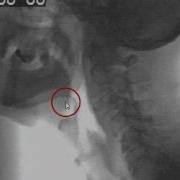 How To Identify Anatomical Landmarks On Videofluorscopy