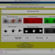 Blood Group Detection Using Image Processing Matlab Project With Source Code