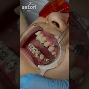 Фиксируем самолигирующие брекеты