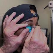 Taking An EyePrint Impression Of An Eye With Advanced Keratoconus