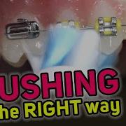 Brushing With Braces Explained Electric Toothbrush Shorts