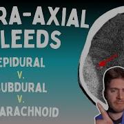 How Do You Tell An Epidural Vs Subdural Vs Subarachnoid Hemorrhage On Non Contrast Head CT