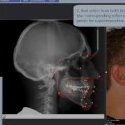 Making Superimposition Of Analysis And Photo In Planmeca Romexis Cephalometric Analysis Module
