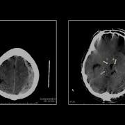 Neuro Trauma II Interesting Radiology Cases