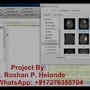 Matlab Source Code For Brain Tumor Detection Using Image Processing