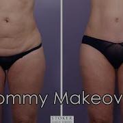 Mommy Makeover Los Angeles Plastic Surgeon Dr David Stoker Completes Patient S Transformation