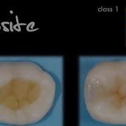 Posterior Direct Composite Class 1 Technique By Tom Youngs