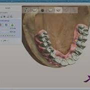 How To Design An Artificial Gingiva For Hybrid Implants Bridge In 3Shape