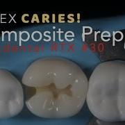 Class II Composite Preparation For ADEX Caries 30 MO