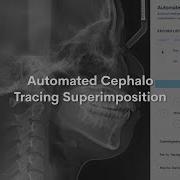 WebCeph Automated Cephalo Tracing Superimposition