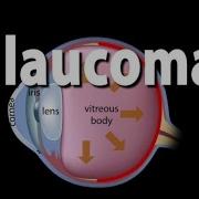 Development Of Glaucoma Animation Open Angle Vs Angle Closure Glaucoma