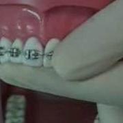 Continuous Ligature Method 1