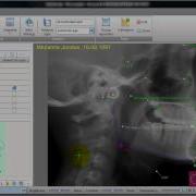 AudaxCeph Analysis