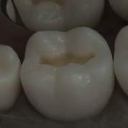 Class I Composite Preparation Restoration Operative Dentistry