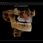 3D Orthodontics Auto CEPH Measurement