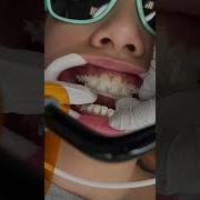 How Braces Are Put On