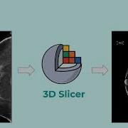 Mammography Lesion Annotation Using 3D Slicer