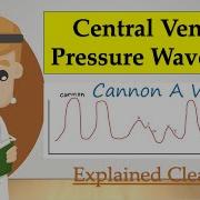 Central Venous Pressure CVP Waveform And Tracing Cannon A Waves