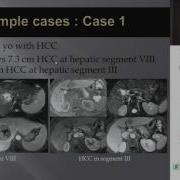 2 Interventional Treatment By TACE And PVE Under Angio CT Dr Ching Charoenvisal