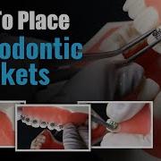 How To Place Orthodontic Brackets Step By Step Guide For Dentists