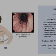 An Approach To GI Bleeding Melena Hematemesis Hematochezia