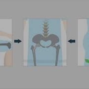 Late Dislocation Following Total Hip Arthroplasty