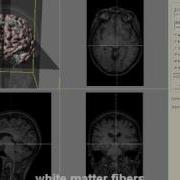 3D Visualization Of Brain DTI Data