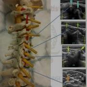 CERVICAL PLEXUS ANATOMY LANDMARK AND US GUIDED BLOCKS
