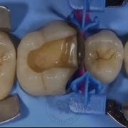 Class 2 Composite Restoration Using Bulk Fill Flowable Composite Sectional Matrices And Wedge