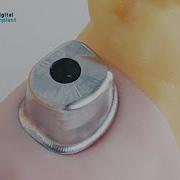 How To Nest A Titanium Abutment Job Via Millbox