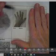Ulnar Vs Radial Loops