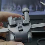 Самолигирующие и традиционные брекеты