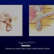 Erectile Dysfunction Solutions After Prostate Cancer Treatment