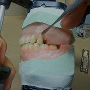 Arranging Teeth For Lingualized Occlusion