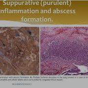 Inflammation Part 6 Systemic Effects And Morphologic Types Of Acute Inflammation